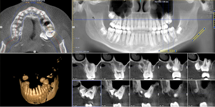 dentalscan roma. dentalscan 3D cone beam roma, dentalscan Roma sud, dentalscan casilina