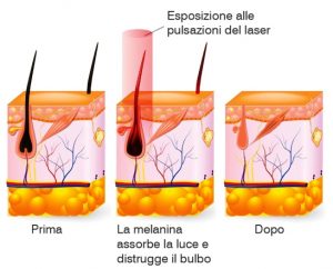 epilazione laser a diodo roma - Epilazione laser Roma