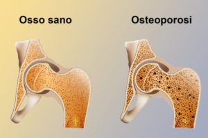 osteoporosi osteopenia