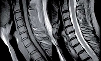 Risonanza magnetica cervicale risonanza magnetica roma | cervicale