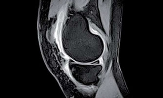 risonanza magnetica del ginocchio