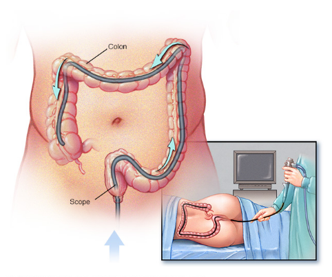 La gastroenterologia - Colonscopia