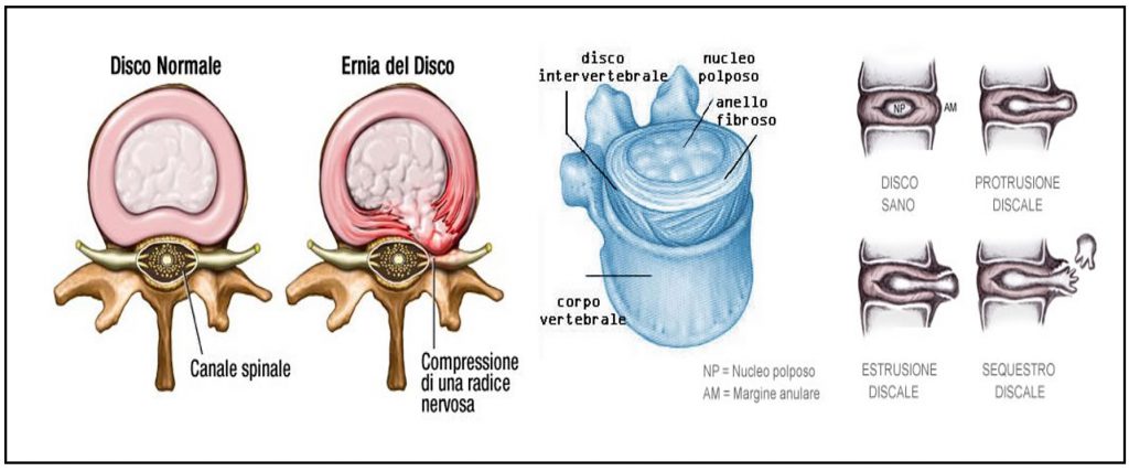 dolore alla cervicale
