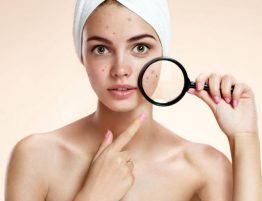 acne - combattere l'acne - parliamo di acne 2