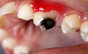 carie e gengivite - Pulizia dei Denti a Roma - Promozione - Igiene Dentale