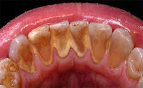 placca tartaro - Pulizia dei Denti a Roma - Promozione - Igiene Dentale