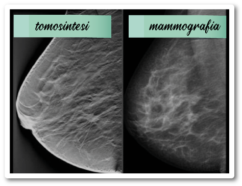 Mammografia e tomosintesi