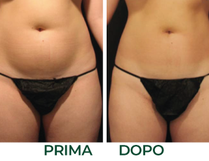 Onde d'urto prima e dopo addome