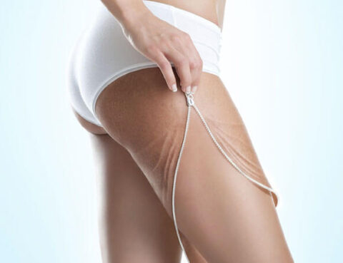 Onde d'urto cellulite