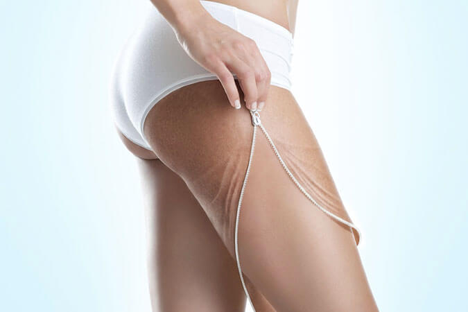 Onde d'urto cellulite