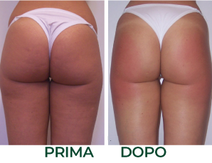 Onde d'urto prima e dopo glutei