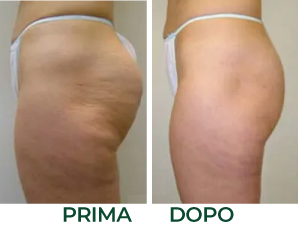 Onde d'urto prima e dopo fianchi