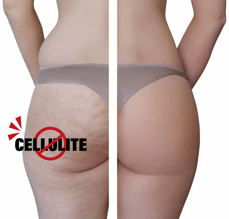 Cellulite