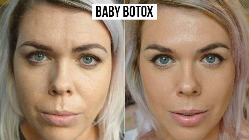 baby botox microbotox