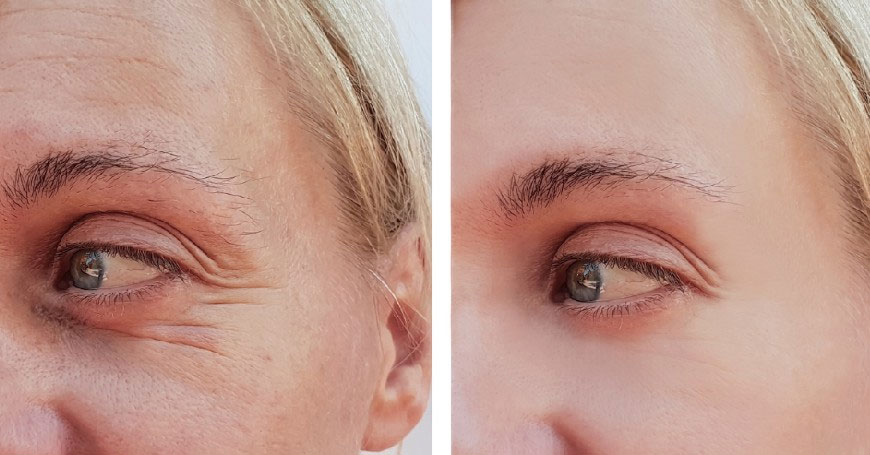 filler occhi - Trattamenti Medicina Estetica