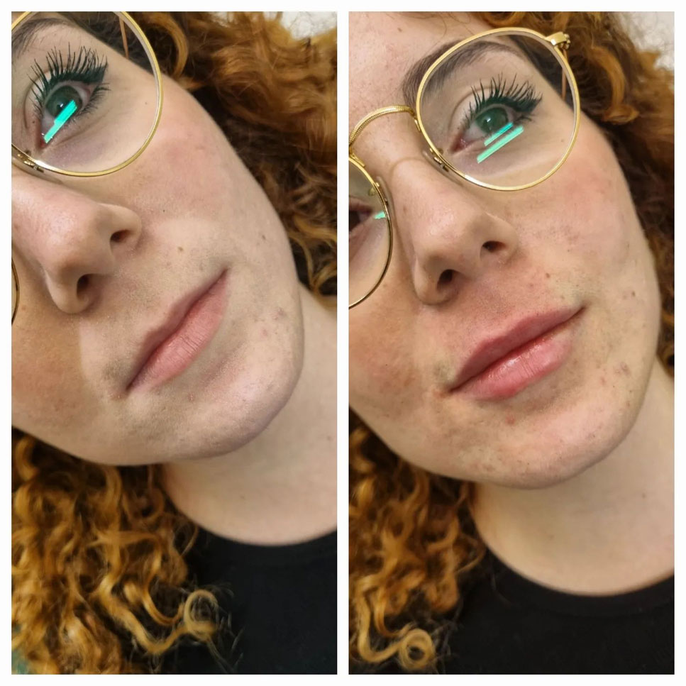 Filler Labbra