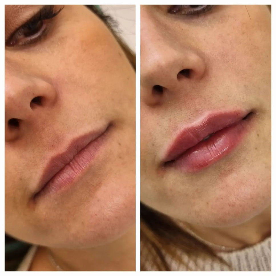 Filler Labbra