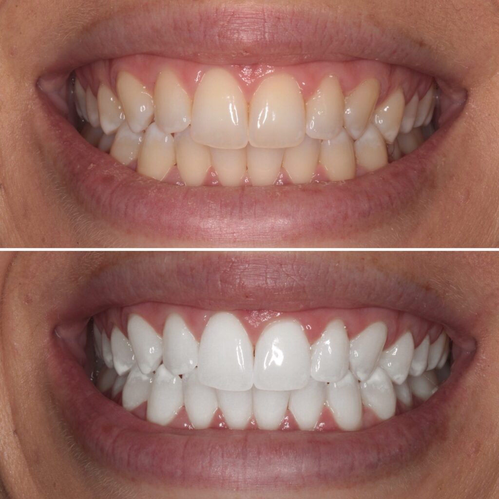 Sbiancamento dentale roma