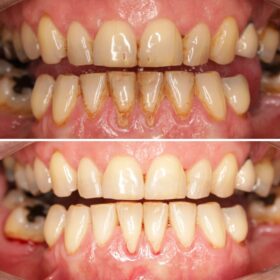 macchie dentali airflow roma