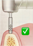 Implantologia Flapless