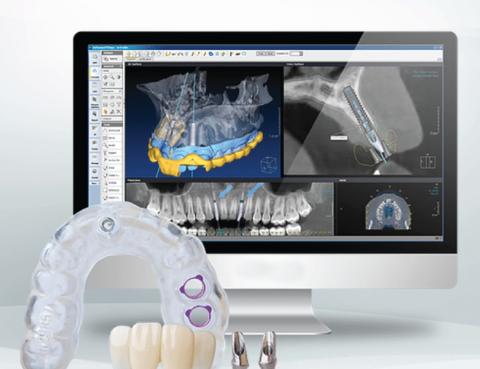 implantologia digitale
